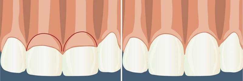 Хирургическое удлинение клинической коронки зуба
