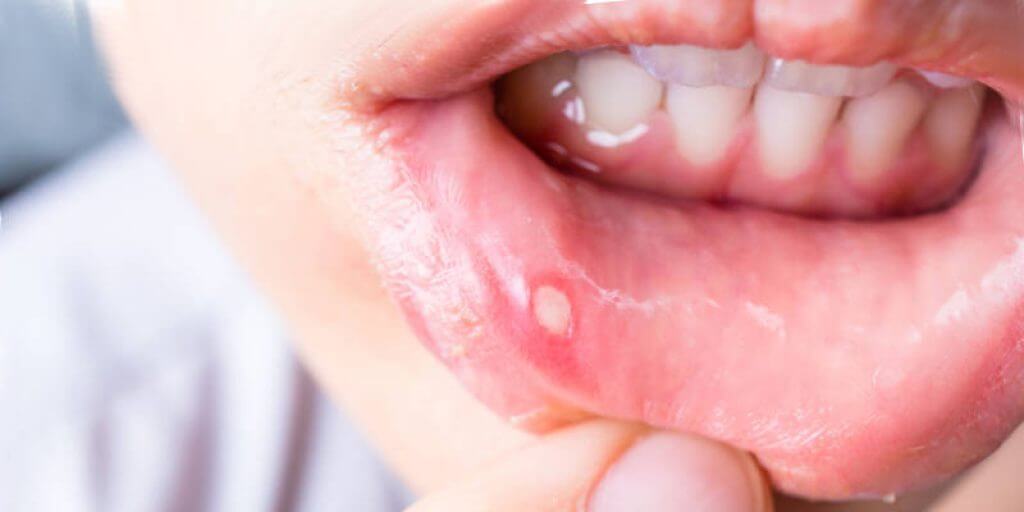 Лечение заболеваний слизистой оболочки полости рта
